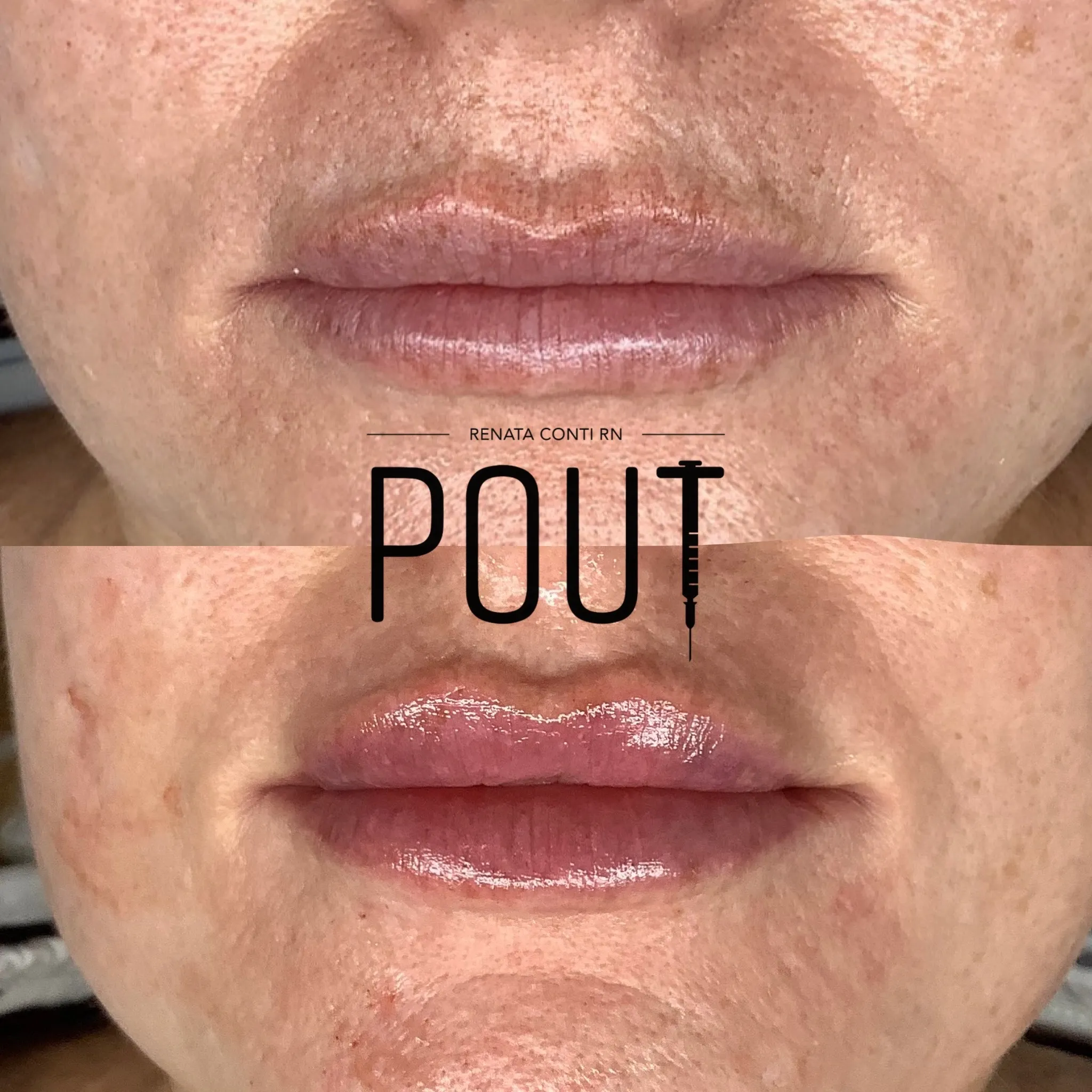 Clean, professional medical spa treatment room with neutral tones at POUT by Renata Conti RN Aesthetics in Andover